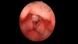 Шкала оценки проявлений рефлюкса по Белафски (RFS)